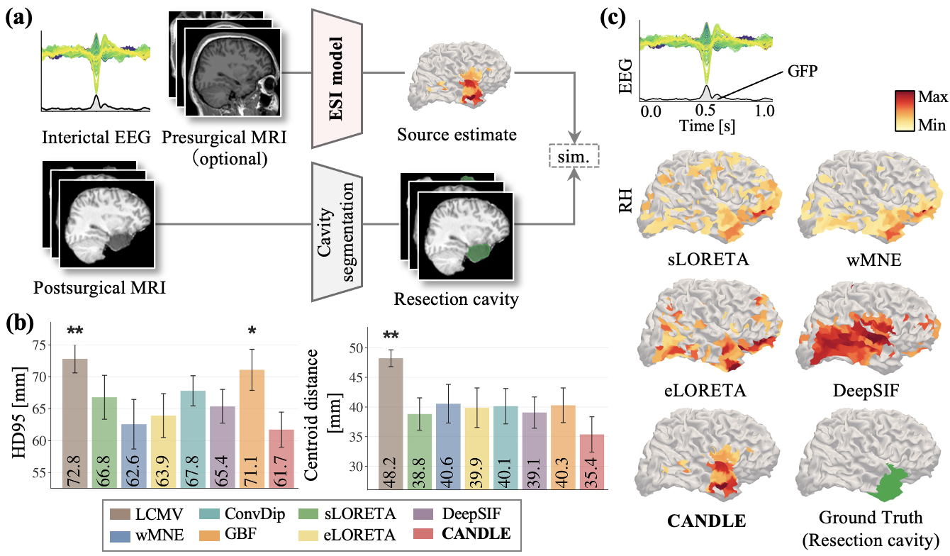 Results for epileptogenic zone estimation